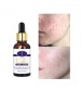 Aichun Beauty New Formula Anti-Acne Whitening Facial Serum 30ml